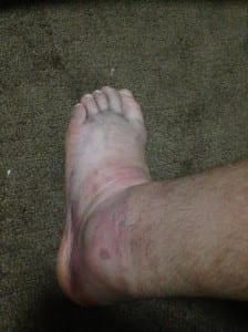 Broken foot 1